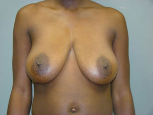 Breast Reduction Before and After Pictures Savannah, GA