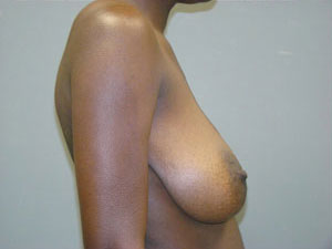 Breast Reduction Before and After Pictures Savannah, GA