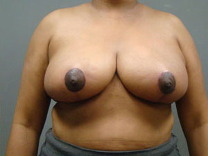 Breast Reduction Before and After Pictures Savannah, GA