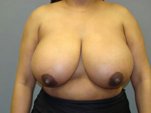 Breast Reduction Before and After Pictures Savannah, GA