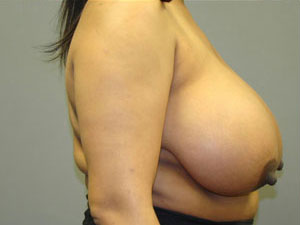Breast Reduction Before and After Pictures Savannah, GA