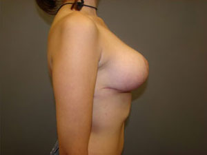 Breast Reduction Before and After Pictures Savannah, GA