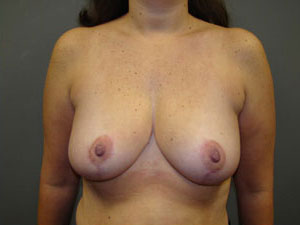 Breast Reduction Before and After Pictures Savannah, GA