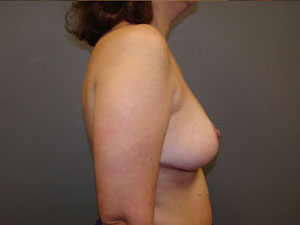 Breast Reduction Before and After Pictures Savannah, GA