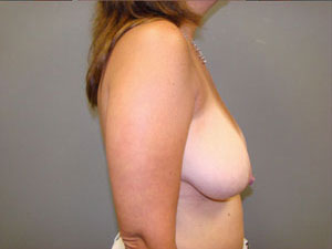 Breast Reduction Before and After Pictures Savannah, GA