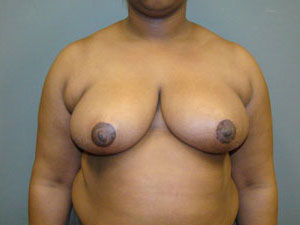 Breast Reduction Before and After Pictures Savannah, GA