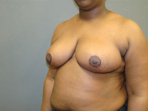 Breast Reduction Before and After Pictures Savannah, GA