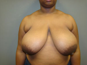 Breast Reduction Before and After Pictures Savannah, GA