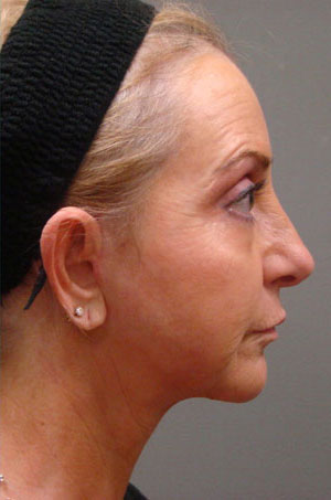 Facelift Before and After Pictures Savannah, GA