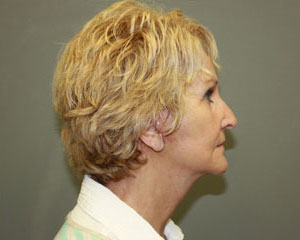 FreshLook Lift® Before and After Pictures Savannah, GA