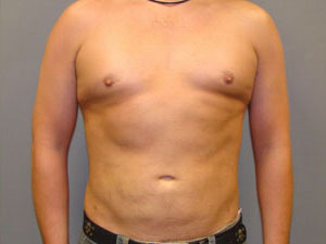 Liposuction Before and After Pictures Savannah, GA
