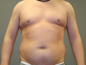 Liposuction Before and After Pictures Savannah, GA