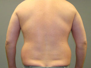 Liposuction Before and After Pictures Savannah, GA