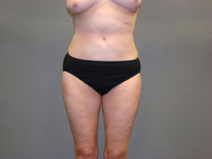 Liposuction Before and After Pictures Savannah, GA