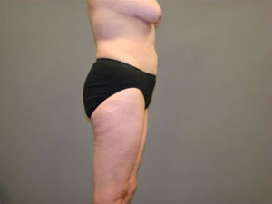 Liposuction Before and After Pictures Savannah, GA