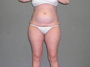 Liposuction Before and After Pictures Savannah, GA