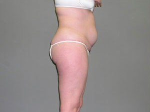 Liposuction Before and After Pictures Savannah, GA