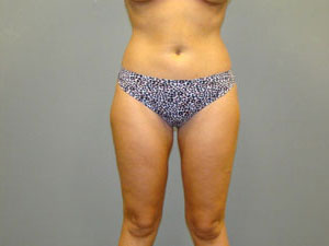 Liposuction Before and After Pictures Savannah, GA