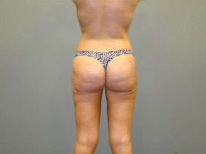 Liposuction Before and After Pictures Savannah, GA