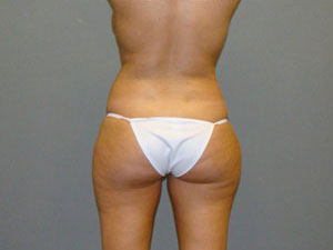 Liposuction Before and After Pictures Savannah, GA