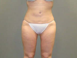 Liposuction Before and After Pictures Savannah, GA