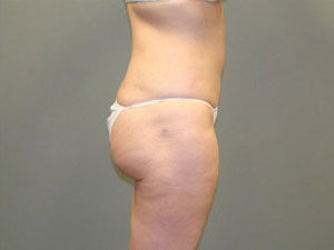 Liposuction Before and After Pictures Savannah, GA