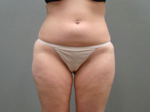 Liposuction Before and After Pictures Savannah, GA