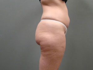 Liposuction Before and After Pictures Savannah, GA