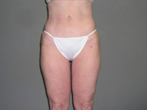 Liposuction Before and After Pictures Savannah, GA