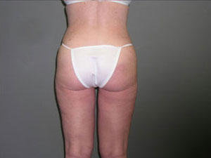Liposuction Before and After Pictures Savannah, GA