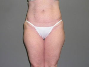 Liposuction Before and After Pictures Savannah, GA