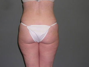 Liposuction Before and After Pictures Savannah, GA
