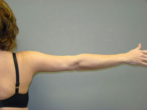 Liposuction Before and After Pictures Savannah, GA