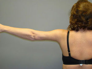 Liposuction Before and After Pictures Savannah, GA