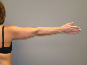 Liposuction Before and After Pictures Savannah, GA