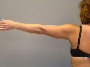 Liposuction Before and After Pictures Savannah, GA