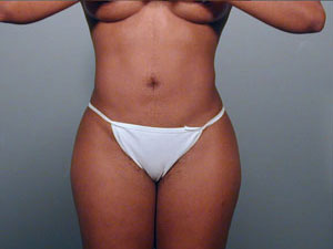 Liposuction Before and After Pictures Savannah, GA