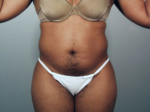 Liposuction Before and After Pictures Savannah, GA