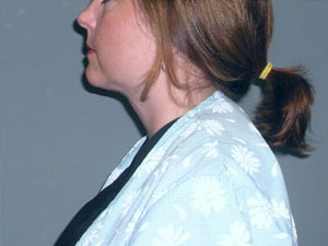 Liposuction Before and After Pictures Savannah, GA