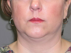Liposuction Before and After Pictures Savannah, GA