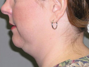 Liposuction Before and After Pictures Savannah, GA