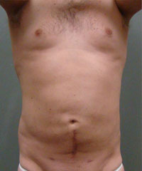 Liposuction Before and After Pictures Savannah, GA
