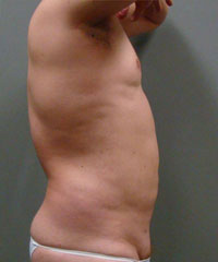 Liposuction Before and After Pictures Savannah, GA