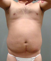 Liposuction Before and After Pictures Savannah, GA