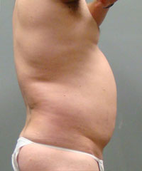 Liposuction Before and After Pictures Savannah, GA