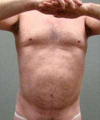 Liposuction Before and After Pictures Savannah, GA