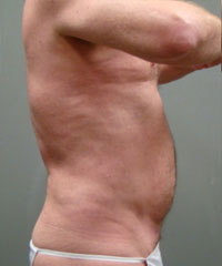 Liposuction Before and After Pictures Savannah, GA