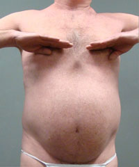 Liposuction Before and After Pictures Savannah, GA