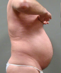 Liposuction Before and After Pictures Savannah, GA