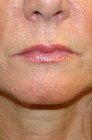 Dermal Fillers & Injectables Before and After Pictures Savannah, GA